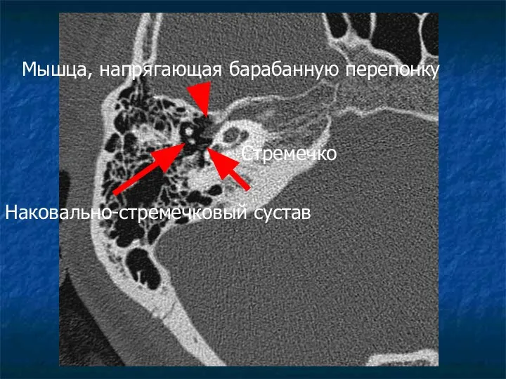 Стремечко Мышца, напрягающая барабанную перепонку Наковально-стремечковый сустав