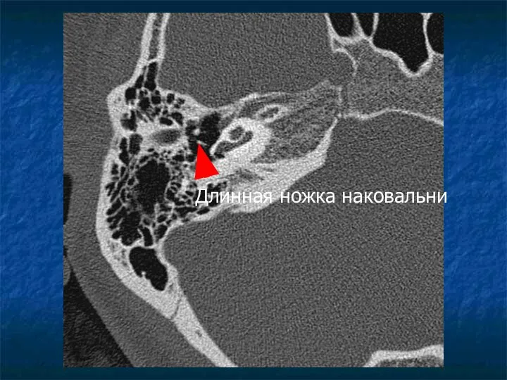 Длинная ножка наковальни