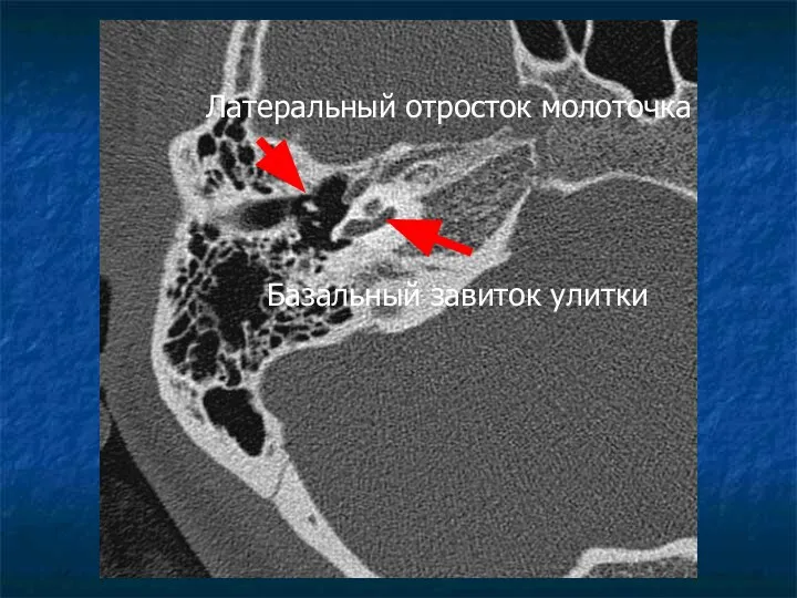 Латеральный отросток молоточка Базальный завиток улитки