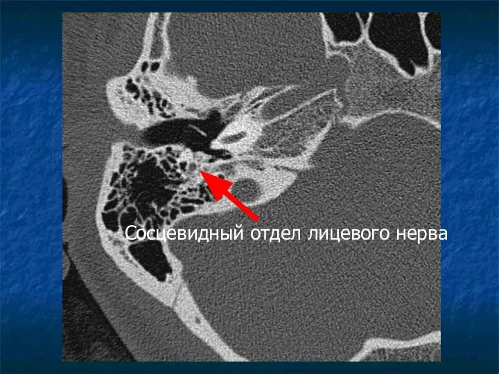 Сосцевидный отдел лицевого нерва