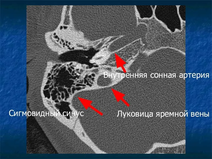 Луковица яремной вены Сигмовидный синус Внутренняя сонная артерия