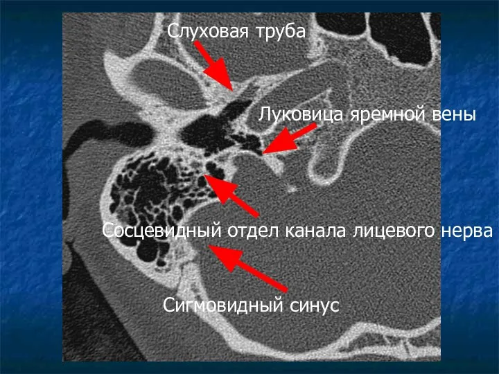 Сигмовидный синус Луковица яремной вены Сосцевидный отдел канала лицевого нерва Слуховая труба