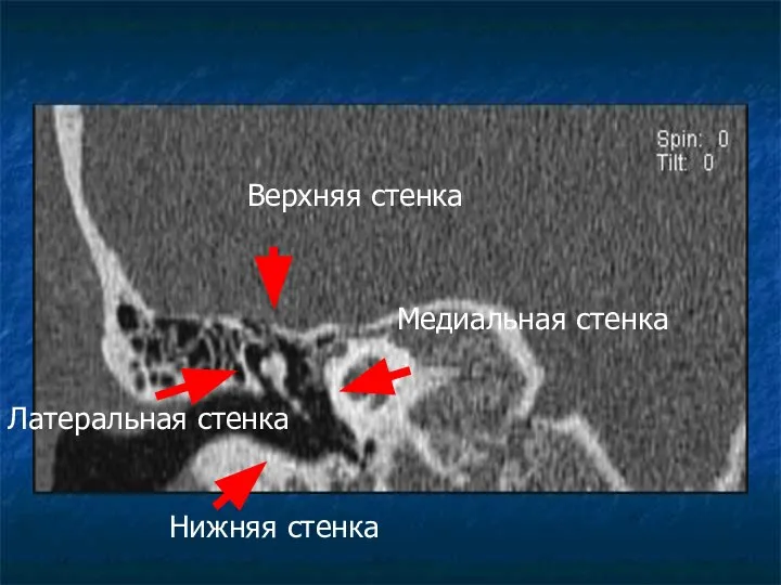 Верхняя стенка Медиальная стенка Латеральная стенка Нижняя стенка