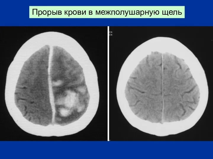 Прорыв крови в межполушарную щель