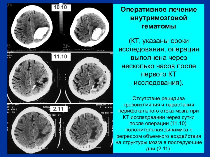 Оперативное лечение внутримозговой гематомы (КТ, указаны сроки исследования, операция выполнена через