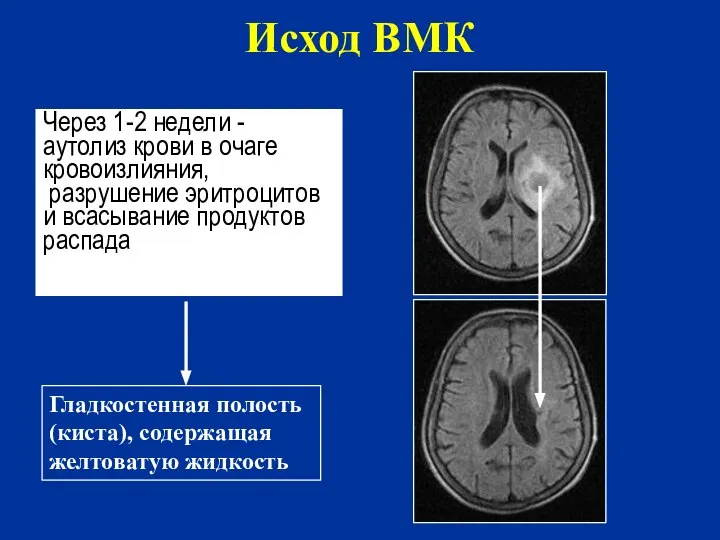 Через 1-2 недели - аутолиз крови в очаге кровоизлияния, разрушение эритроцитов