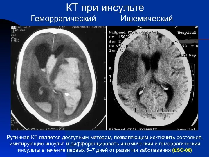 КТ при инсульте Геморрагический Ишемический Рутинная КТ является доступным методом, позволяющим