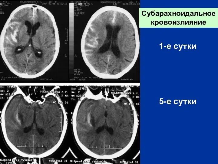 Субарахноидальное кровоизлияние 1-е сутки 5-е сутки