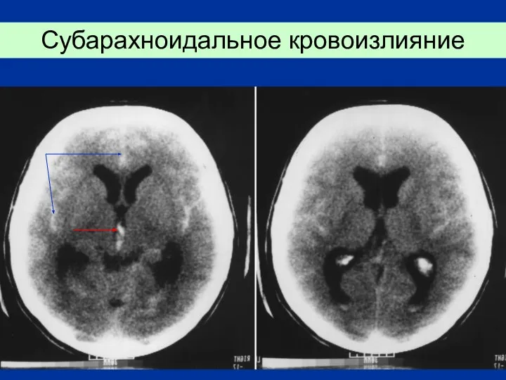 Субарахноидальное кровоизлияние