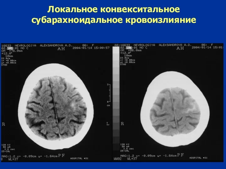 Локальное конвекситальное субарахноидальное кровоизлияние