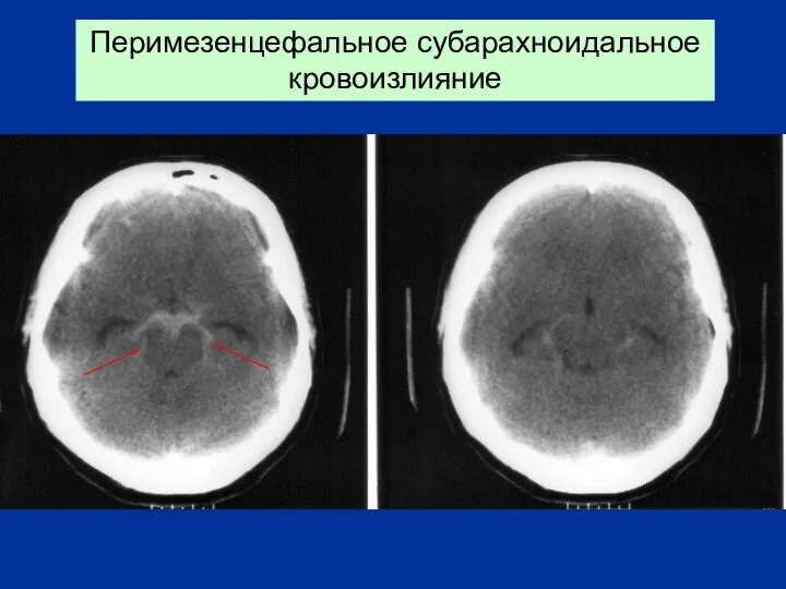 Перимезенцефальное субарахноидальное кровоизлияние