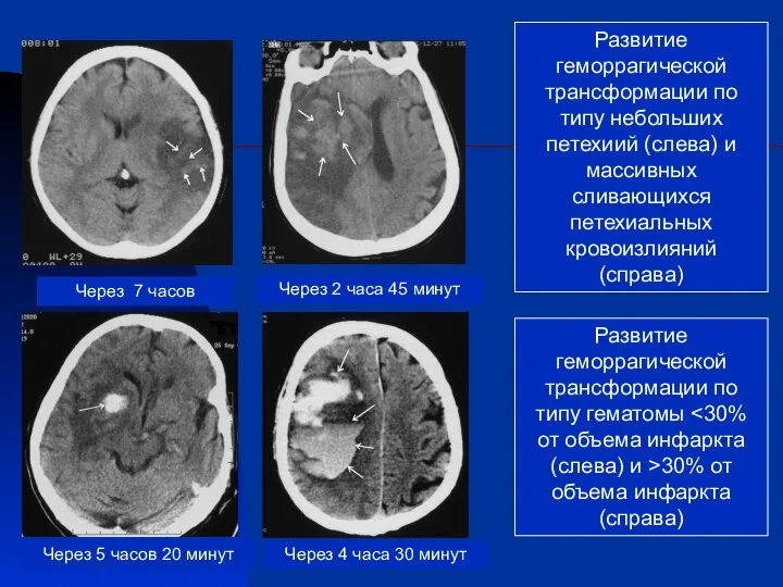 Развитие геморрагической трансформации по типу небольших петехиий (слева) и массивных сливающихся