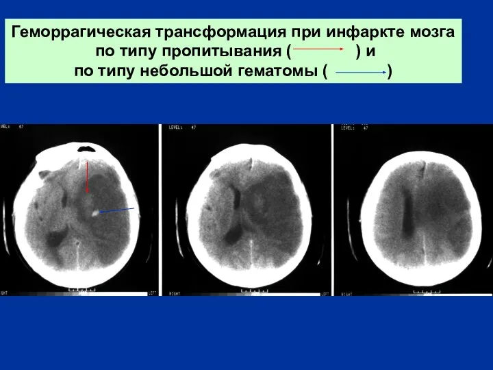 Геморрагическая трансформация при инфаркте мозга по типу пропитывания ( ) и