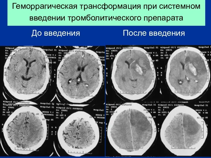 Геморрагическая трансформация при системном введении тромболитического препарата До введения После введения