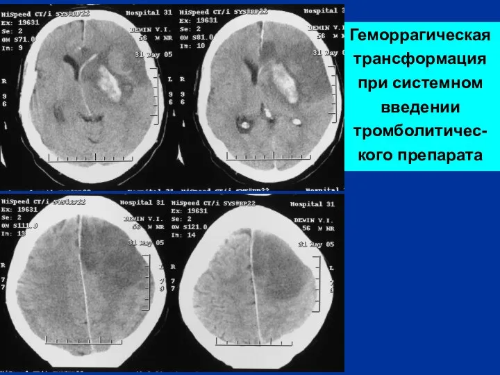 Геморрагическая трансформация при системном введении тромболитичес-кого препарата