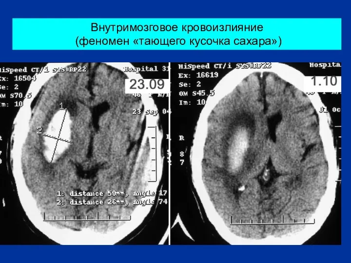 Внутримозговое кровоизлияние (феномен «тающего кусочка сахара»)