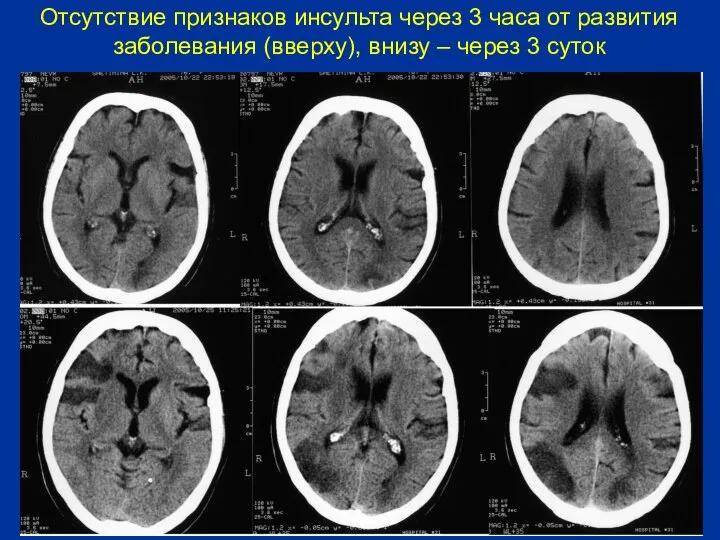 Отсутствие признаков инсульта через 3 часа от развития заболевания (вверху), внизу – через 3 суток