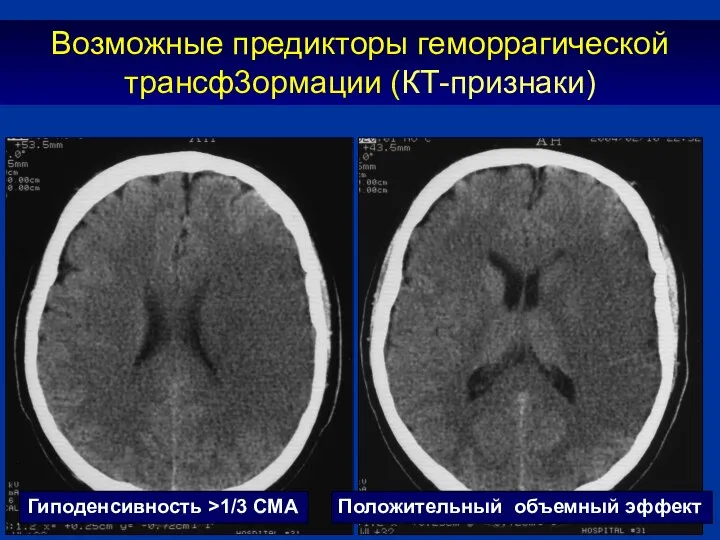 Возможные предикторы геморрагической трансф3ормации (КТ-признаки) Гиподенсивность >1/3 СМА Положительный объемный эффект