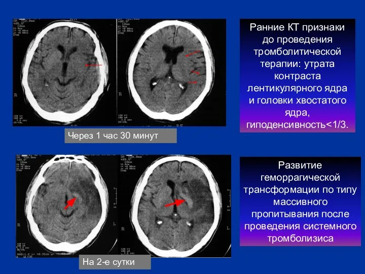 Ранние КТ признаки до проведения тромболитической терапии: утрата контраста лентикулярного ядра