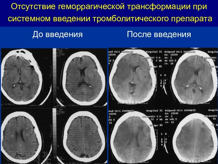 Отсутствие геморрагической трансформации при системном введении тромболитического препарата До введения После введения