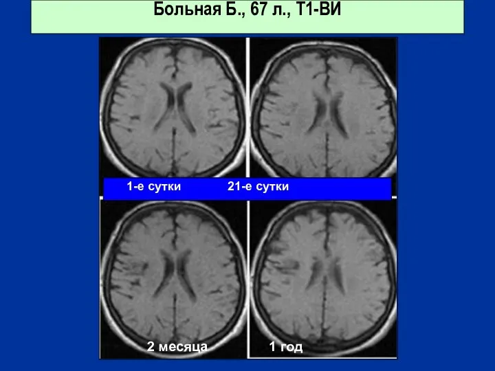 Больная Б., 67 л., Т1-ВИ 1-е сутки 21-е сутки 2 месяца 1 год