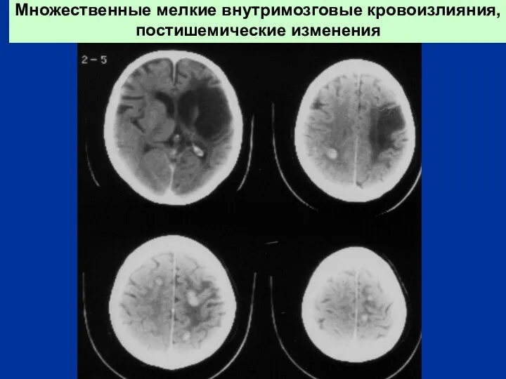 Множественные мелкие внутримозговые кровоизлияния, постишемические изменения