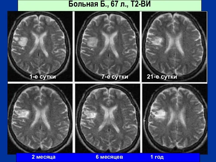 Больная Б., 67 л., Т2-ВИ 2 месяца 6 месяцев 1 год