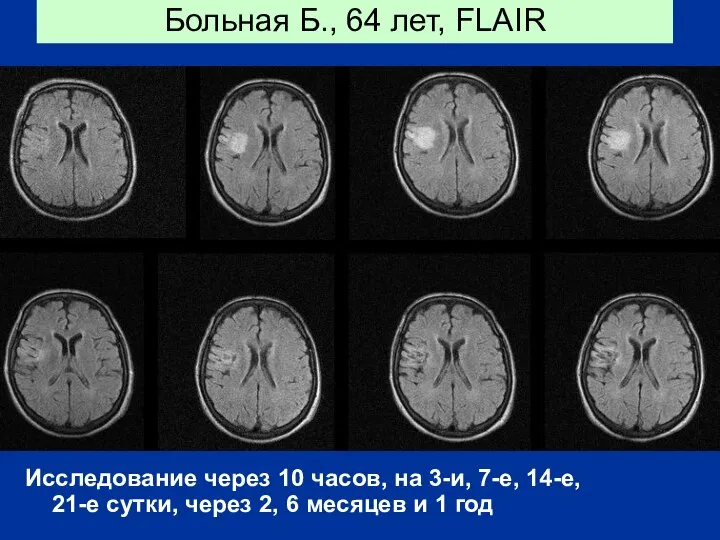 Больная Б., 64 лет, FLAIR Исследование через 10 часов, на 3-и,