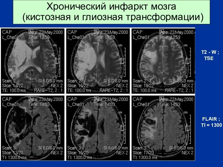 Хронический инфаркт мозга (кистозная и глиозная трансформации) FLAIR ; TI =