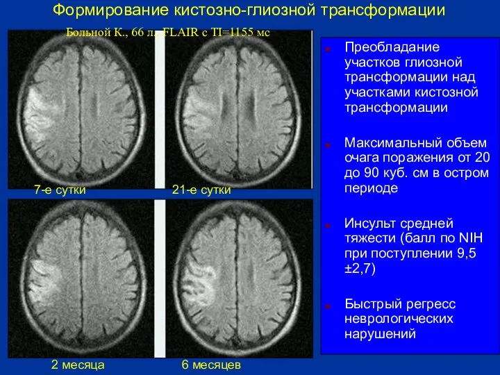 Преобладание участков глиозной трансформации над участками кистозной трансформации Максимальный объем очага