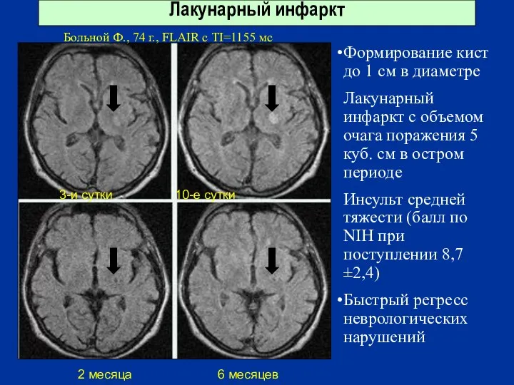 Лакунарный инфаркт 3-и сутки 10-е сутки 2 месяца 6 месяцев Больной