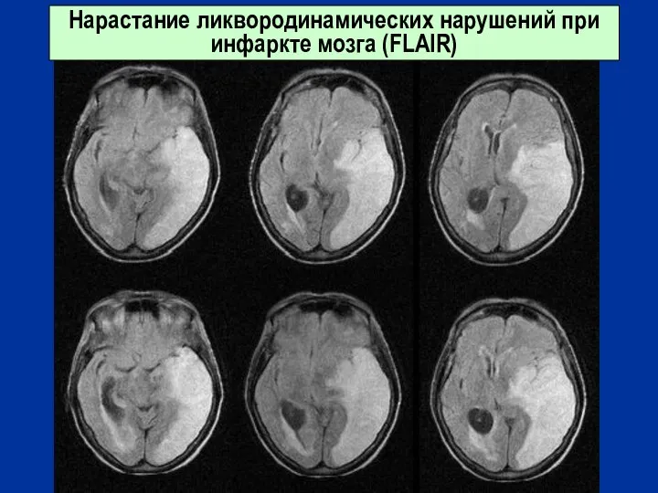 Нарастание ликвородинамических нарушений при инфаркте мозга (FLAIR)