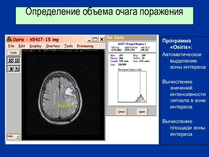 Определение объема очага поражения Программа «Osiris»: Автоматическое выделение зоны интереса Вычисление