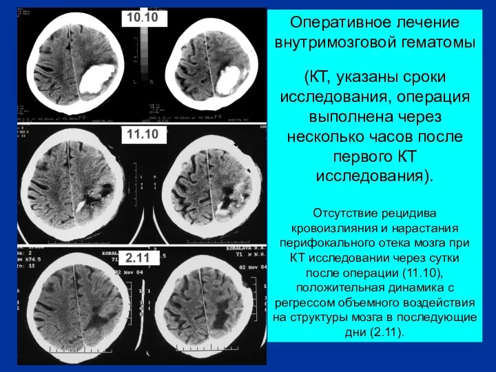 Оперативное лечение внутримозговой гематомы (КТ, указаны сроки исследования, операция выполнена через