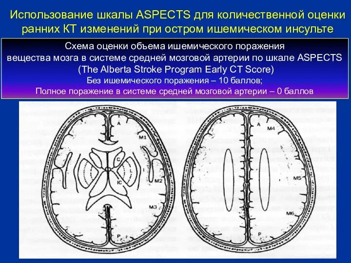 Схема оценки объема ишемического поражения вещества мозга в системе средней мозговой