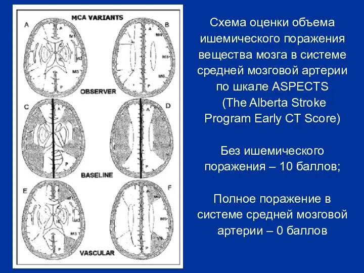 Схема оценки объема ишемического поражения вещества мозга в системе средней мозговой