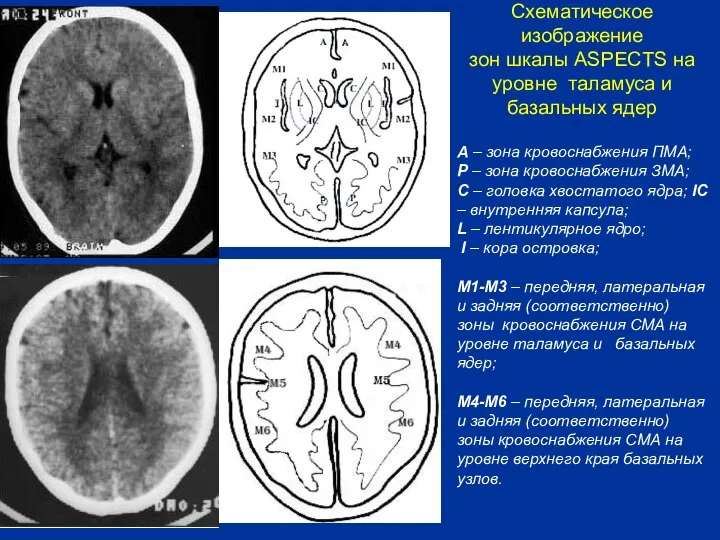 Схематическое изображение зон шкалы ASPECTS на уровне таламуса и базальных ядер