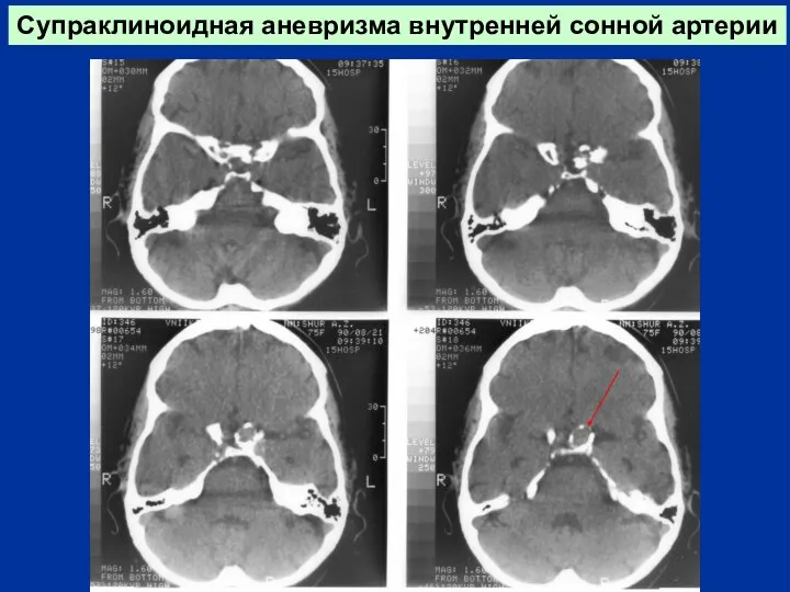 Супраклиноидная аневризма внутренней сонной артерии