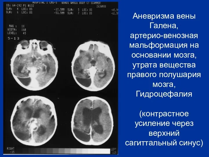 Аневризма вены Галена, артерио-венозная мальформация на основании мозга, утрата вещества правого