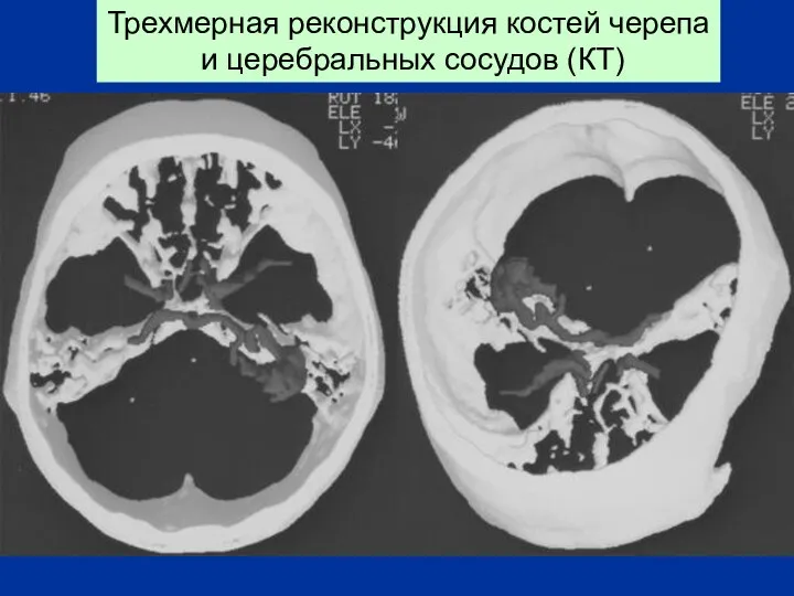 Трехмерная реконструкция костей черепа и церебральных сосудов (КТ)