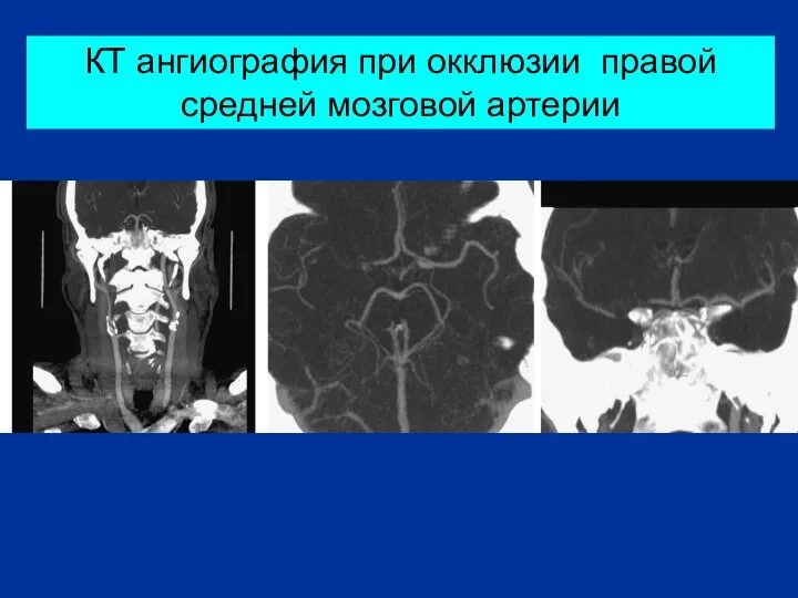 КТ ангиография при окклюзии правой средней мозговой артерии