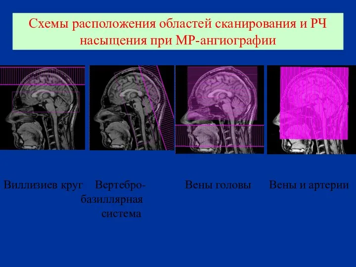 Виллизиев круг Вертебро- базиллярная система Схемы расположения областей сканирования и РЧ