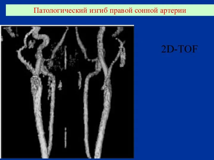 Патологический изгиб правой сонной артерии 2D-TOF