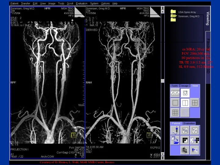 Carotid Imaging ce MRA; 20 cc Gd FOV 206x300 mm; 80