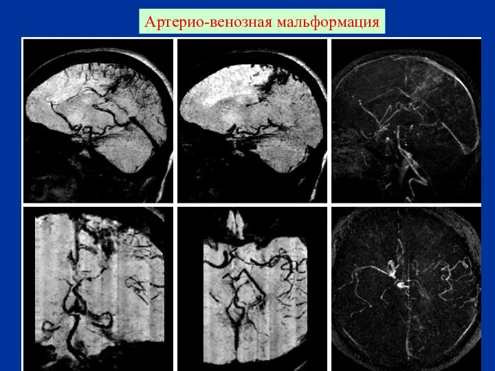 Артерио-венозная мальформация