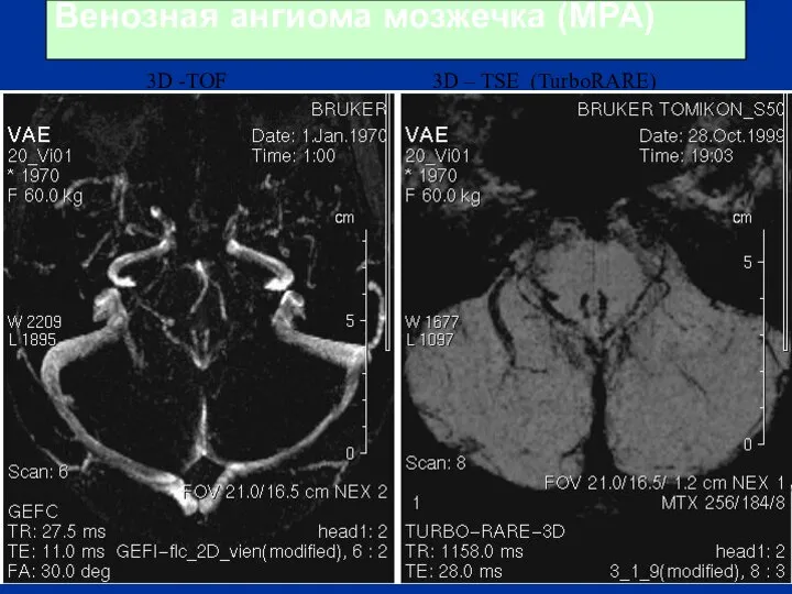 Венозная ангиома мозжечка (МРА) 3D -TOF 3D – TSE (TurboRARE)