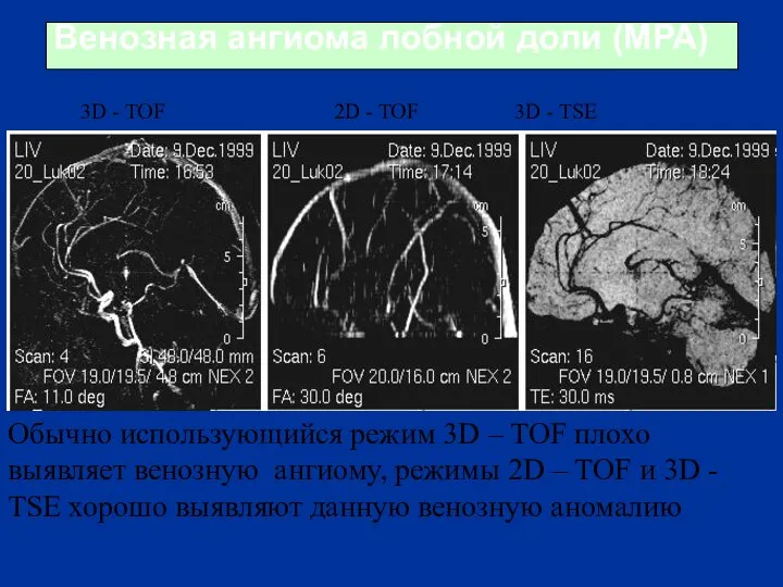 Венозная ангиома лобной доли (МРА) 3D - TOF 2D - TOF