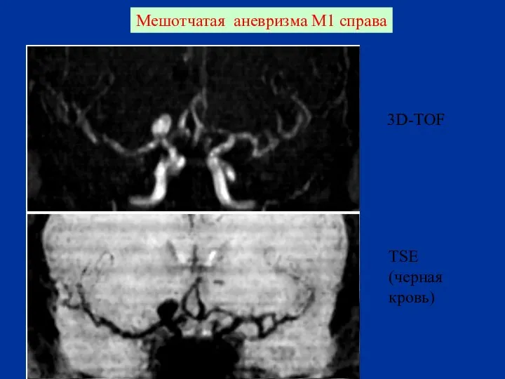 Мешотчатая аневризма М1 справа 3D-TOF TSE (черная кровь)
