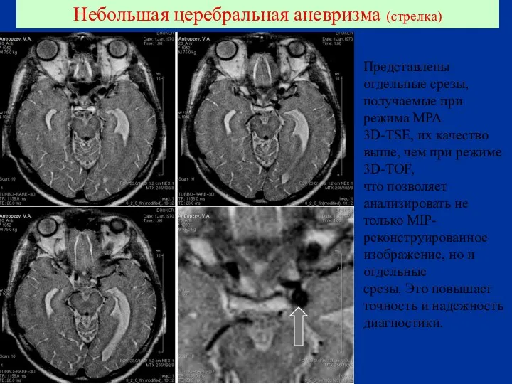 Небольшая церебральная аневризма (стрелка) Представлены отдельные срезы, получаемые при режима МРА