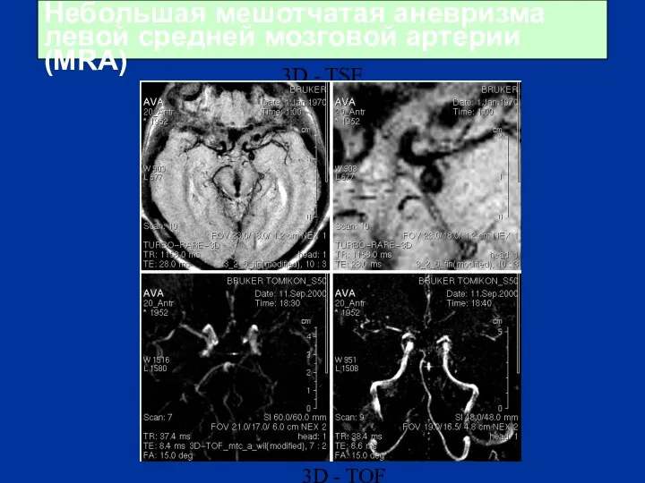 Небольшая мешотчатая аневризма левой средней мозговой артерии (MRA) 3D - TSE 3D - TOF